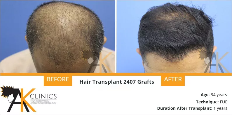 Best Hair Transplant clinics in Bangalore 2023
