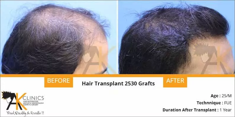 Hair Transplant for Men  Women  100 safe  Free Consultation
