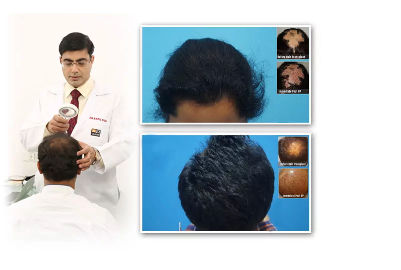 Hair Mate Clinic on Twitter Hair Transplant in Pune  Hairline Hair  Transplant  For Hair Transplantation Visit Hairmate clinic amp for more  details callWhatsApp us on  9191750 44004  hairmate 